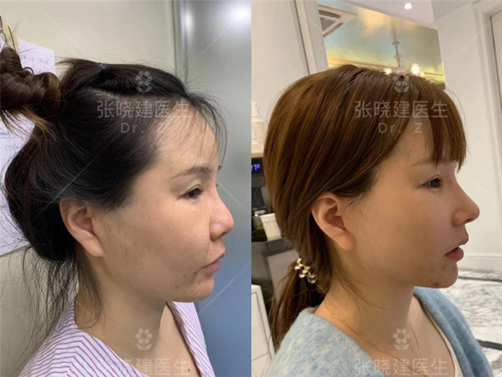 深圳面部提升专家