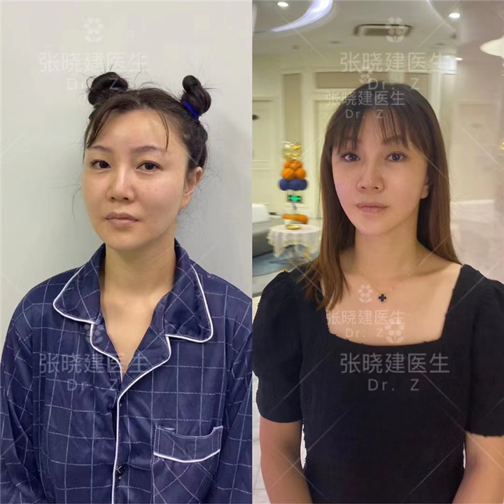 深圳面部异物取出