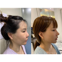 深圳面部提升专家