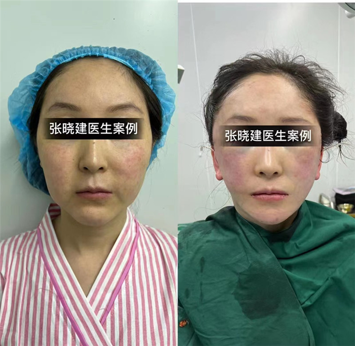 香港面部异物取出医生