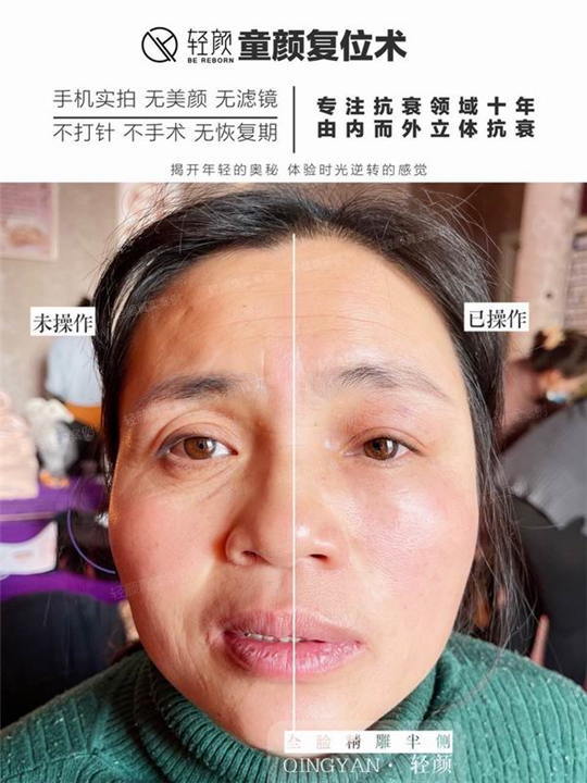 3D童颜复位术培训 