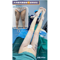 济南大腿吸脂