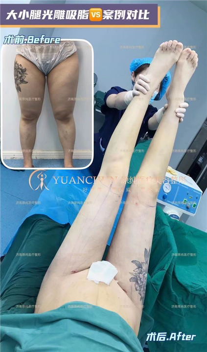 济南大腿吸脂
