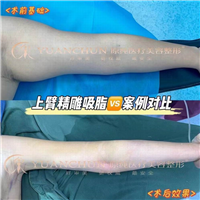 济南手臂吸脂