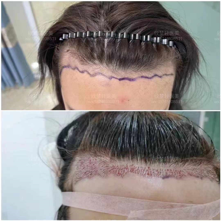 0血水吸脂