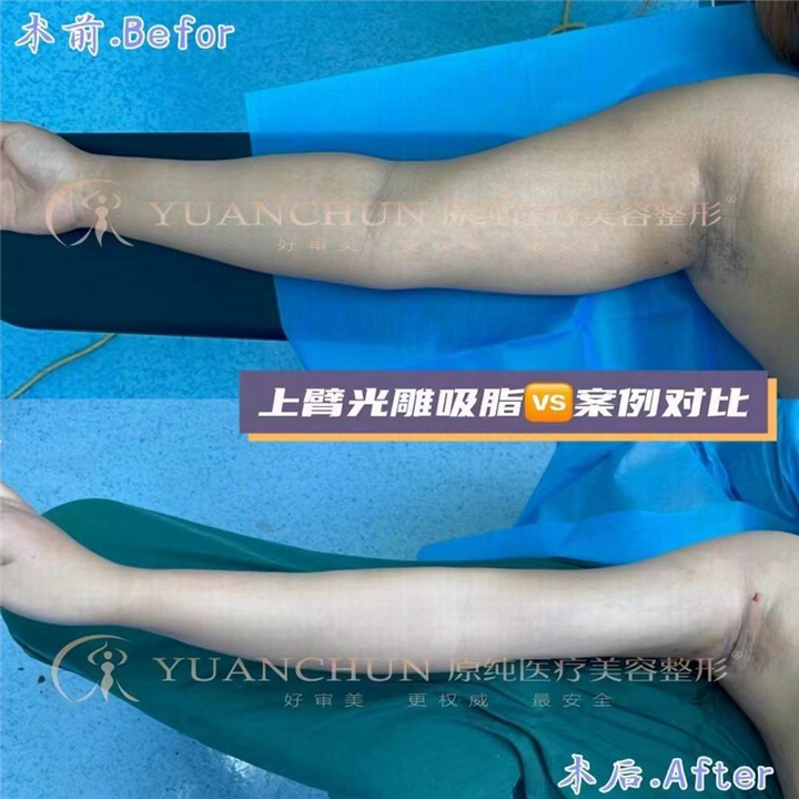 济南手臂吸脂
