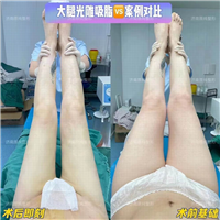 济南大腿吸脂