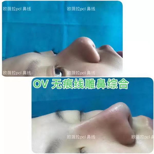 UVERLA线雕