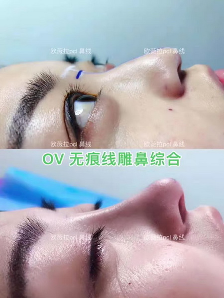 UVERLA线雕