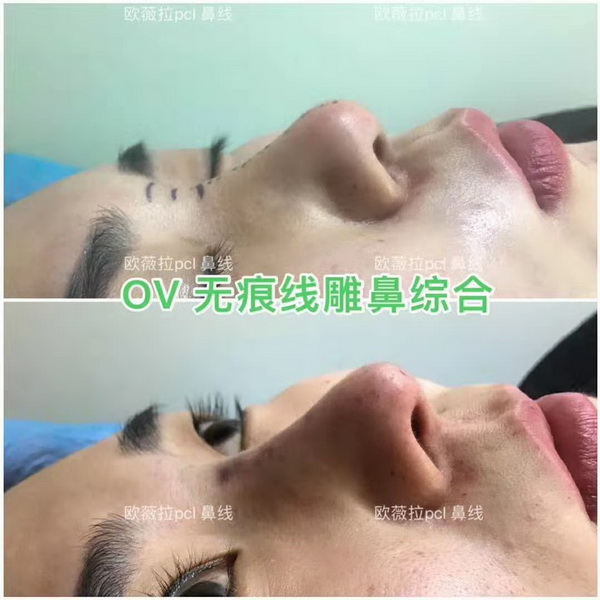 UVERLA线雕