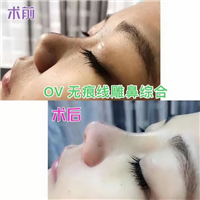 UVERLA线雕