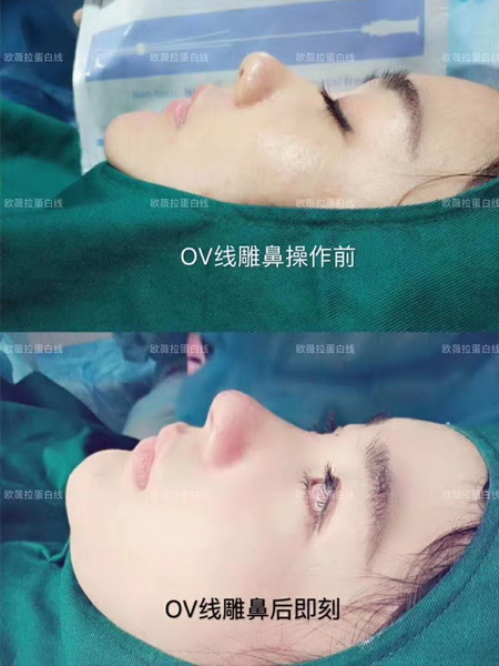 UVERLA线雕