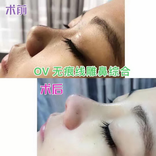UVERLA线雕