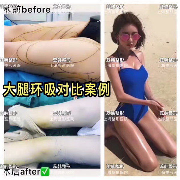 上海哪里做下巴整形好