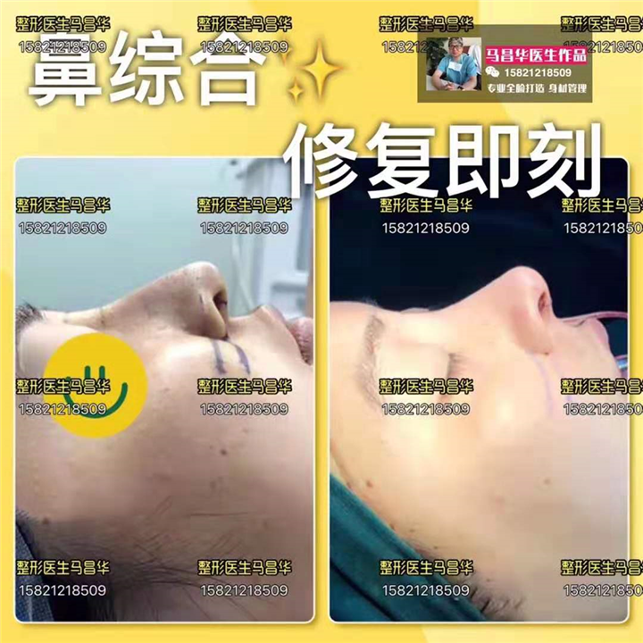 上海鼻综合修复