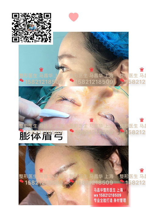 膨体眉**整形 
