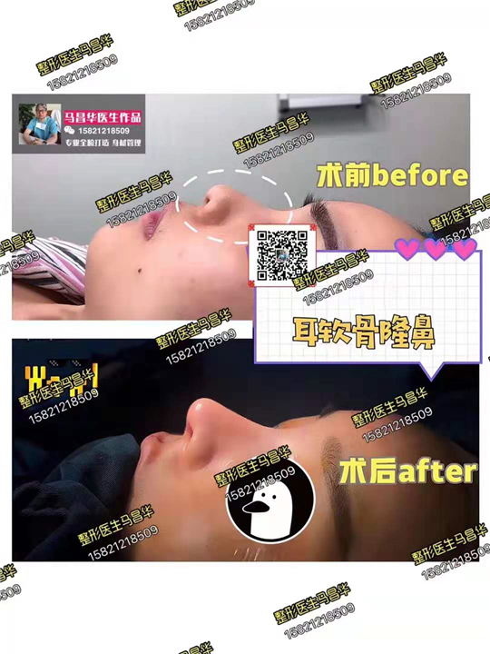 上海鼻综合修复