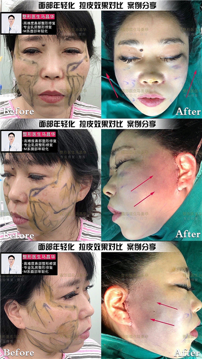 马昌华医生拉皮手术面部提升 