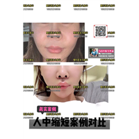 上海人中缩短术 