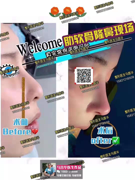 上海鼻综合修复