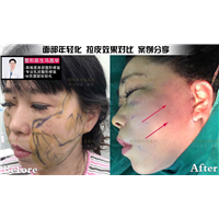 上海拉皮手术面部提升 