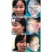 上海马昌华医生拉皮提升 