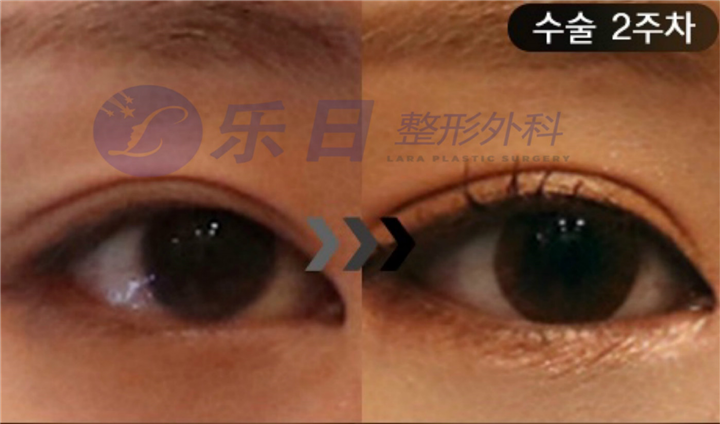 眼修复