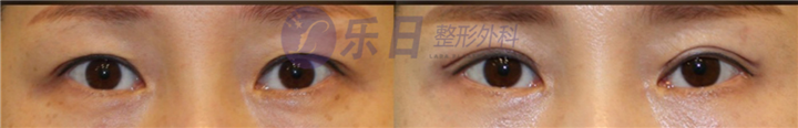 眼修复对比