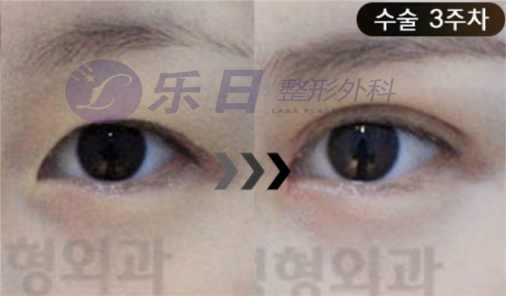 眼修复