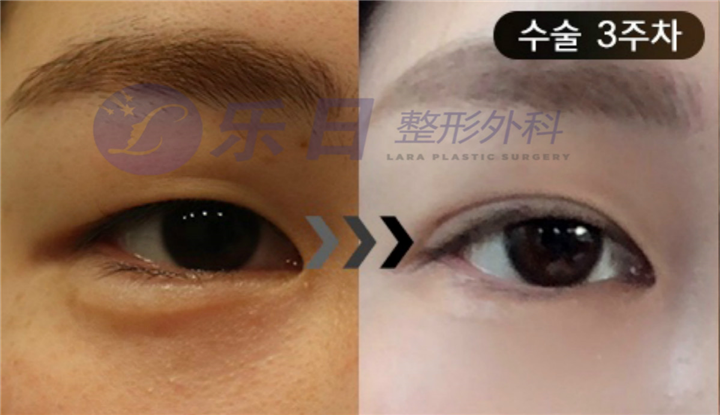 眼修复