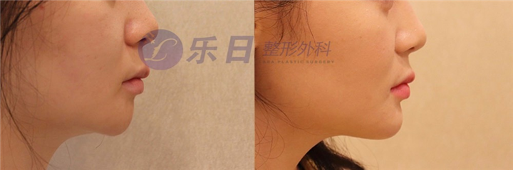 下巴假体