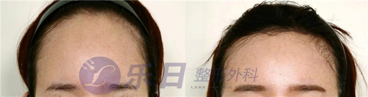 额头前后对比
