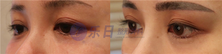 眼部前后对比