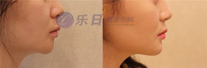 下巴假体