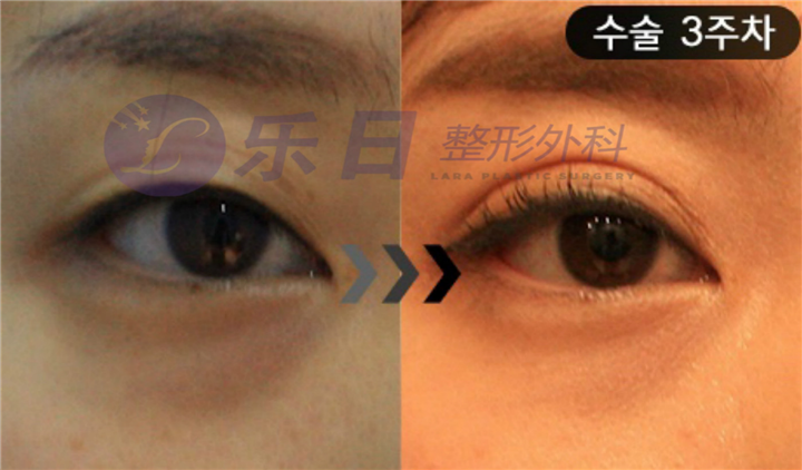 眼修复