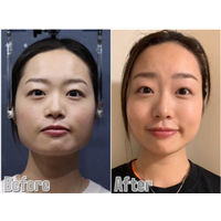 上海日式小颜整骨培训