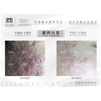 痘坑痘印皮肤修复