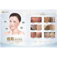 痘肌皮肤修复
