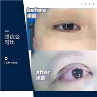 眉眼年轻综合术 