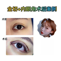 眼部年轻化整形 