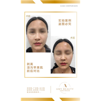 汕头剥离微雕