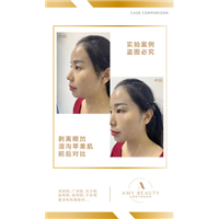汕头剥离微雕