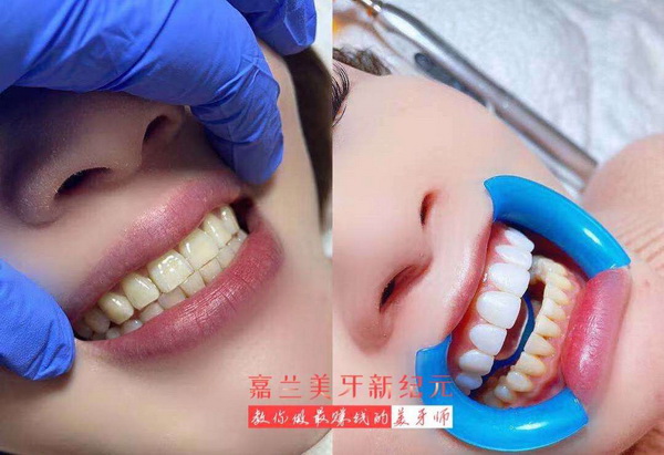 冰瓷美牙培训哪家好 