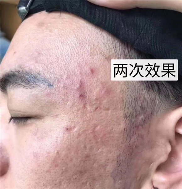 常州清洗纹身