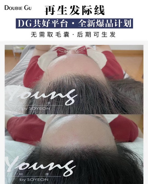Young网红发际线