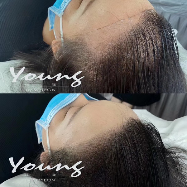 发际线再生种植