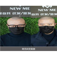 重庆斑秃纹发案例