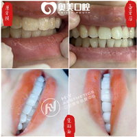 东莞瓷贴面美牙培训