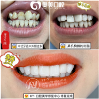 东莞瓷贴面美牙培训