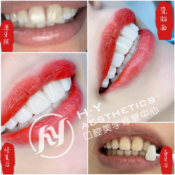 东莞冰瓷美牙培训